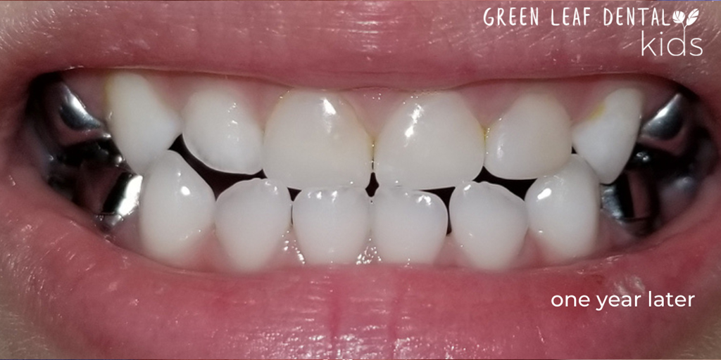 Dental Crowns For Kids Green Leaf Dental